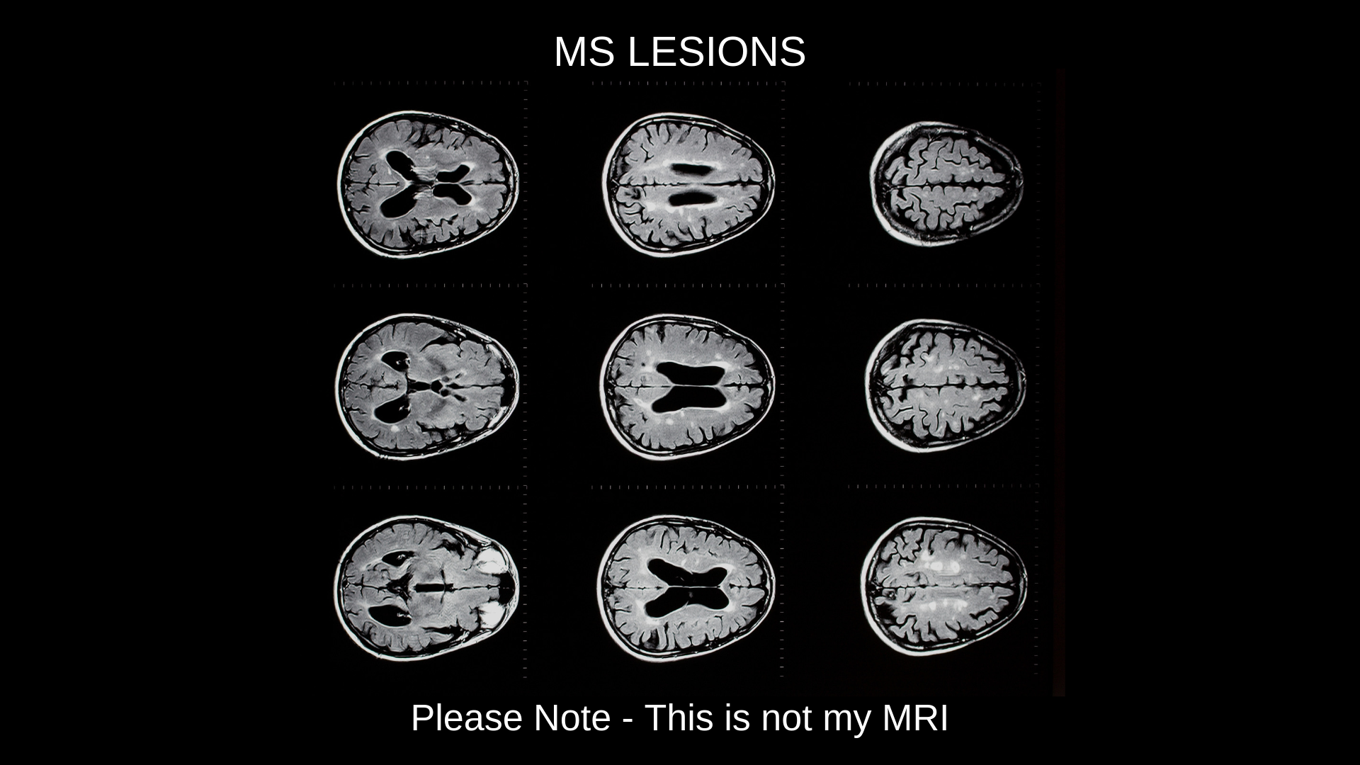 Example MRI with lesions